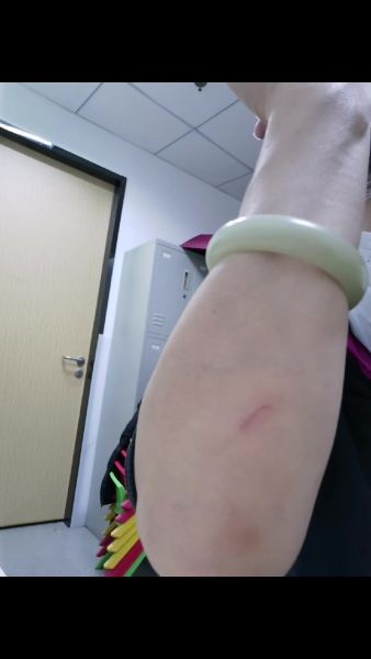 这伤疤象狗咬的吗?